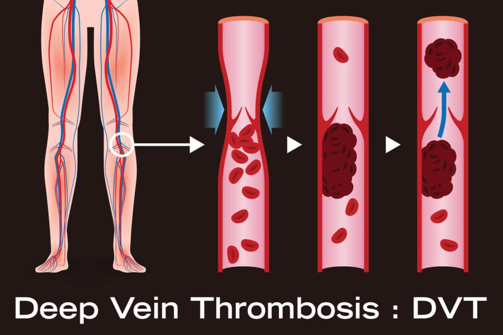 DVT Deep Vein Thrombosis stocking flight socks size large, medical gra