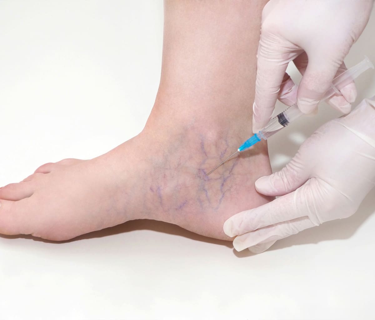 what-causes-spider-veins-on-the-face-by-alexander-perez-issuu