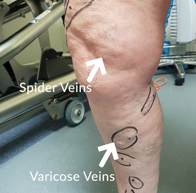 VaricoseVeins_PatientA