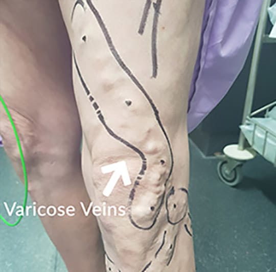 VaricoseVeins_PatientB_new1